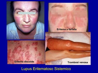 Lupus Eritematoso Sistemico Eritema discoide Eritema a farfalla Trombosi venosa 