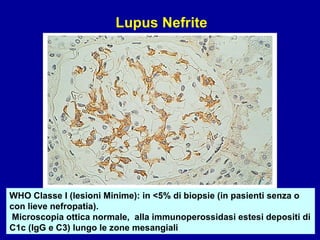 WHO Classe I (lesioni Minime): in <5% di biopsie (in pasienti senza o con lieve nefropatia). Microscopia ottica normale,  alla immunoperossidasi estesi depositi di C1c (IgG e C3) lungo le zone mesangiali Lupus Nefrite 