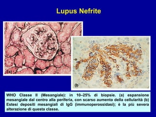 WHO Classe II (Mesangiale): in 10–25% di biopsie. (a) espansione mesangiale dal centro alla periferia, con scarso aumento della cellularità (b) Estesi depositi mesangiali di IgG (immunoperossidasi); è la più severa alterazione di questa classe. (a) (b Lupus Nefrite 