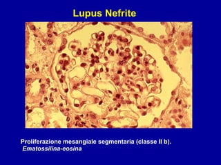 Proliferazione mesangiale segmentaria (classe II b). Ematossilina-eosina Lupus Nefrite 