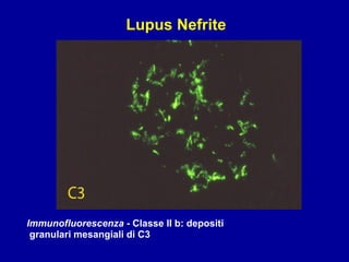 Immunofluorescenza  - Classe II b: depositi granulari mesangiali di C3 Lupus Nefrite 