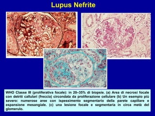 WHO Classe III (proliferativa focale): in 20–35% di biopsie. (a) Area di necrosi focale con detriti callulari (freccia) circondata da proliferazione cellulare (b) Un esempio più severo: numerose aree con ispessimento segmentario della parete capillare e espansione mesangiale. (c) una lesione focale e segmentaria in circa metà del glomerulo. Lupus Nefrite 
