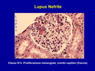 Classe III b .  Proliferazione mesangiale, trombi capillari (freccia) Lupus Nefrite 