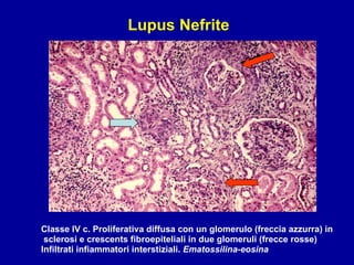 Classe IV c. Proliferativa diffusa con un glomerulo (freccia azzurra) in sclerosi e crescents fibroepiteliali in due glomeruli (frecce rosse) Infiltrati infiammatori interstiziali.  Ematossilina-eosina Lupus Nefrite 