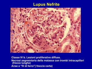 Classe IV b. Lesioni proliferative diffuse. Necrosi segmentaria della matassa con trombi intracapillari  (frecce lunghe) Anse a “fil di ferro”( freccia corta) Lupus Nefrite 