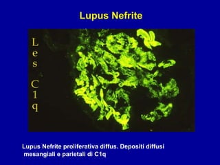Lupus Nefrite proliferativa diffus. Depositi diffusi mesangiali e parietali di C1q Lupus Nefrite 