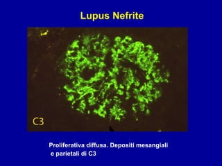 Proliferativa diffusa. Depositi mesangiali e parietali di C3 Lupus Nefrite 