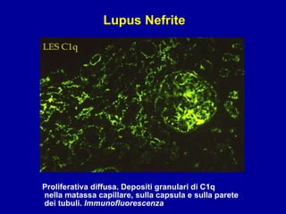 Proliferativa diffusa. Depositi granulari di C1q nella matassa capillare, sulla capsula e sulla parete dei tubuli.  Immunofluorescenza Lupus Nefrite 