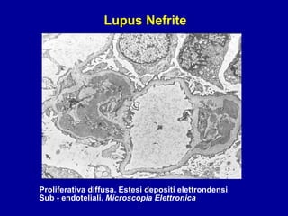 Proliferativa diffusa. Estesi depositi elettrondensi  Sub - endoteliali.  Microscopia Elettronica Lupus Nefrite 