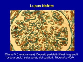 Classe V (membranosa). Depositi parietali diffusi (in granuli rosso arancio) sulla parete dei capillari.  Tricromica 400x Lupus Nefrite 