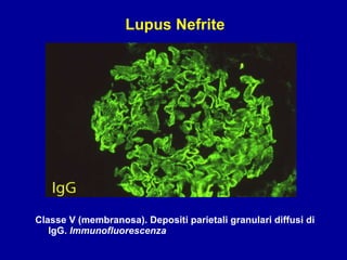 Classe V (membranosa). Depositi parietali granulari diffusi di IgG.  Immunofluorescenza Lupus Nefrite 