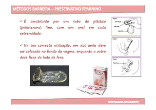 É constituído por um tubo de plástico
(poliuterano) fino, com um anel em cada
extremidade.
Na sua correcta utilização, um dos anéis deve
ser colocado no fundo da vagina, enquanto o outro
deve ficar do lado de fora.deve ficar do lado de fora.
 