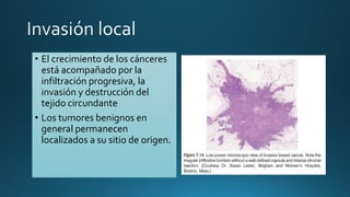 • El crecimiento de los cánceres
está acompañado por la
infiltración progresiva, la
invasión y destrucción del
tejido circundante
• Los tumores benignos en
general permanecen
localizados a su sitio de origen.
 