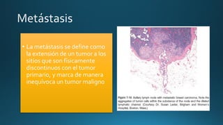 • La metástasis se define como
la extensión de un tumor a los
sitios que son físicamente
discontinuos con el tumor
primario, y marca de manera
inequívoca un tumor maligno
 