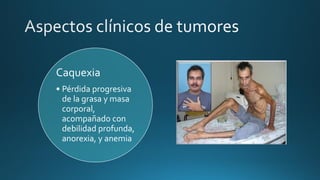 Caquexia
• Pérdida progresiva
de la grasa y masa
corporal,
acompañado con
debilidad profunda,
anorexia, y anemia
 