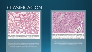 Tumores benignos. su apariencia macro y microscópica
implica que permanecerá localizado, no se extenderá a otros
sitios, y es susceptible de extirpación quirúrgica local
Tumores malignos pueden invadir y destruir las
estructuras adyacentes y diseminarse a sitios distantes
(metástasis) y causar la muerte.
 