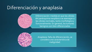Diferenciación: medida en que las células
del parénquima neoplásico se asemejan a
las células normales, tanto morfológica y
funcionalmente. En general, los tumores
benignos son bien diferenciados
Anaplasia: falta de diferenciación, se
considera una característica de
malignidad.
 