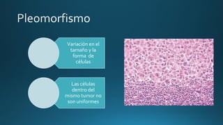 Variación en el
tamaño y la
forma de
células
Las células
dentro del
mismo tumor no
son uniformes
 