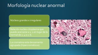 Núcleos grandes e irregulares
Relación nucleo-citoplasma que
puede acercarse a 1: 1 en lugar de la
normal de 1: 4 o 1: 6.
La cromatina esta densamente
agrupada (hipercromáticos)
 
