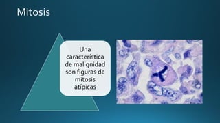 Una
característica
de malignidad
son figuras de
mitosis
atípicas
 