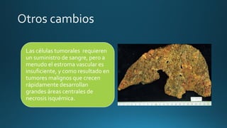 Las células tumorales requieren
un suministro de sangre, pero a
menudo el estroma vascular es
insuficiente, y como resultado en
tumores malignos que crecen
rápidamente desarrollan
grandes áreas centrales de
necrosis isquémica.
 