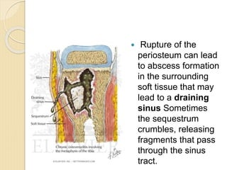 5-OSTEOMYELITIS and SEPTIC ARTHRITIS.ppt