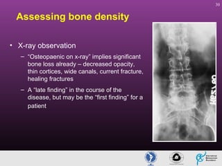 30

Assessing bone density
• X-ray observation
– “Osteopaenic on x-ray” implies significant
bone loss already – decreased opacity,
thin cortices, wide canals, current fracture,
healing fractures
– A “late finding” in the course of the
disease, but may be the “first finding” for a
patient

 