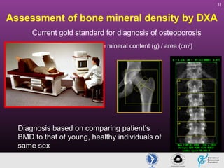 31

Assessment of bone mineral density by DXA
Current gold standard for diagnosis of osteoporosis
BMD (g/cm2) = Bone mineral content (g) / area (cm2)

Diagnosis based on comparing patient’s
BMD to that of young, healthy individuals of
same sex

 