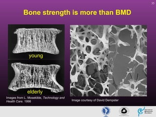 35

Bone strength is more than BMD

young

elderly
Images from L. Mosekilde, Technology and
Health Care. 1998

Image courtesy of David Dempster

 