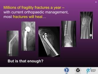 41

Millions of fragility fractures a year –
with current orthopaedic management,
most fractures will heal…

But is that enough?

 