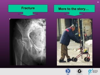 46

Fracture

More to the story…

 