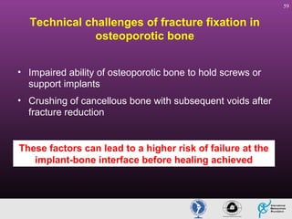 59

Technical challenges of fracture fixation in
osteoporotic bone
• Impaired ability of osteoporotic bone to hold screws or
support implants
• Crushing of cancellous bone with subsequent voids after
fracture reduction

These factors can lead to a higher risk of failure at the
implant-bone interface before healing achieved

 