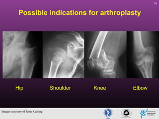 61

Possible indications for arthroplasty

Hip

Images courtesy of John Keating

Shoulder

Knee

Elbow

 