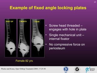 63

Example of fixed angle locking plates
POST OP

1 MONTH

1 YEAR

• Screw head threaded –
engages with hole in plate
• Single mechanical unit –
internal fixator
• No compressive force on
periosteum

Female 82 yrs
Plecko and Kraus, Oper Orthop Traumatol.2005; 17:25-50

 