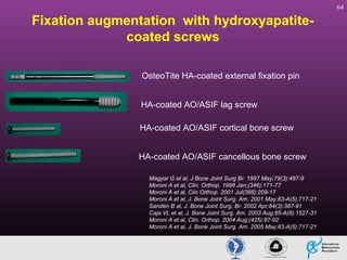 64

Fixation augmentation with hydroxyapatitecoated screws
OsteoTite HA-coated external fixation pin
HA-coated AO/ASIF lag screw
HA-coated AO/ASIF cortical bone screw
HA-coated AO/ASIF cancellous bone screw
Magyar G et al, J Bone Joint Surg Br. 1997 May;79(3):487-9
Moroni A et al, Clin. Orthop. 1998 Jan;(346):171-77
Moroni A et al, Clin Orthop. 2001 Jul(388):209-17
Moroni A et al, J. Bone Joint Surg. Am. 2001 May;83-A(5):717-21
Sandèn B al, J. Bone Joint Surg. Br. 2002 Apr;84(3):387-91
Caja VL et al, J. Bone Joint Surg. Am. 2003 Aug;85-A(8):1527-31
Moroni A et al, Clin. Orthop. 2004 Aug;(425):87-92
Moroni A et al, J. Bone Joint Surg. Am. 2005 May;83-A(5):717-21

 
