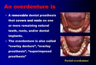 Overlay Temporary Denture 5- OVERDENTURE.pptx