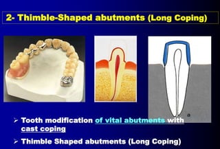 Ast Coping Tooth 5- OVERDENTURE.pptx