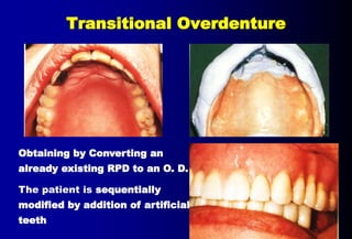 Transitional Rpd Single Tooth 5- OVERDENTURE.pptx