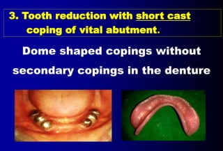 Ast Coping Tooth 5- OVERDENTURE.pptx