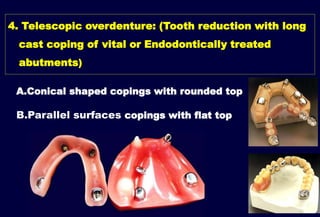 Ast Coping Tooth 5- OVERDENTURE.pptx