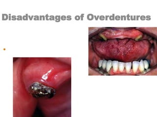 Disadvantages of Overdentures
• Caries susceptibility.
 