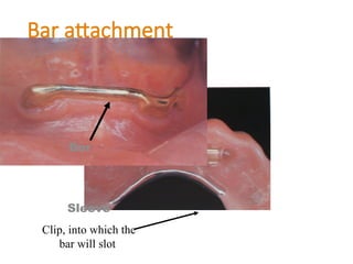 Bar attachment
Sleeve
Clip, into which the
bar will slot
Bar
 