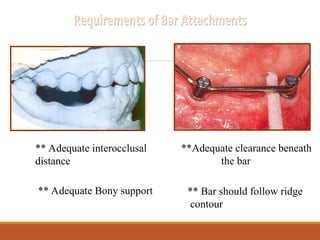 ** Adequate interocclusal
distance
**Adequate clearance beneath
the bar
** Adequate Bony support ** Bar should follow ridge
contour
 