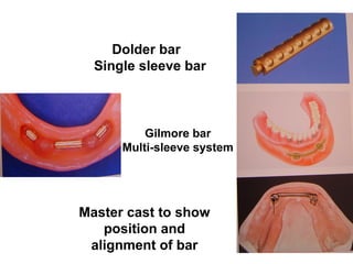 Dolder bar
Single sleeve bar
Gilmore bar
Multi-sleeve system
Master cast to show
position and
alignment of bar
 