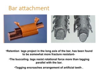 Bar attachment
•Retention tags project in the long axis of the bar, has been found
to be somewhat more fracture resistant-
•The buccoling. tags resist rotational force more than tagging
parallel with the bar.
•Tagging encroaches arrangement of artificial teeth .
 