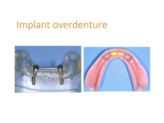 Implant overdenture
 
