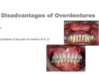 Disadvantages of Overdentures
• Bony undercuts:
Limitation of the path of insertion of O. D.
 