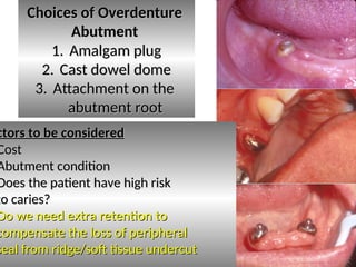 Choices of Overdenture
Choices of Overdenture
Abutment
Abutment
1.
1. Amalgam plug
Amalgam plug
2.
2. Cast dowel dome
Cast dowel dome
3.
3. Attachment on the
Attachment on the
abutment root
abutment root
ctors to be considered
ctors to be considered
Cost
Cost
Abutment condition
Abutment condition
Does the patient have high risk
Does the patient have high risk
to caries?
to caries?
Do we need extra retention to
Do we need extra retention to
compensate the loss of peripheral
compensate the loss of peripheral
seal from ridge/soft tissue undercut
seal from ridge/soft tissue undercut
 