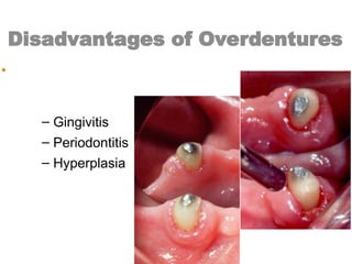 Disadvantages of Overdentures
• Periodontal breakdown
of the abutment teeth.
– Gingivitis
– Periodontitis
– Hyperplasia
 