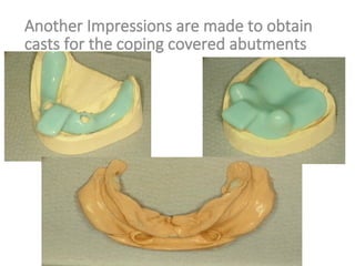 Another Impressions are made to obtain
casts for the coping covered abutments
 